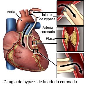Cirugía de injerto de bypass de la arteria coronaria (CABG)