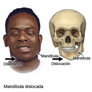 Mandíbula dislocada