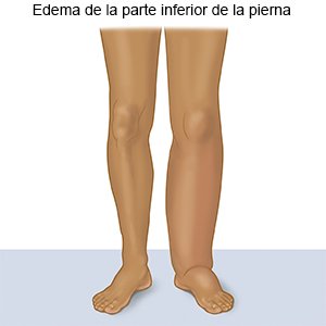 Edema de la parte inferior de la pierna