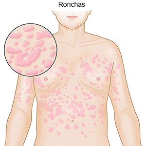 Ronchas