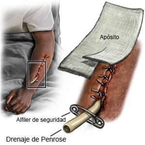 Drenaje de Penrose
