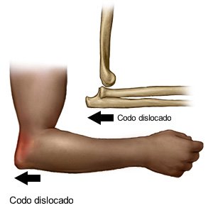 Codo dislocado