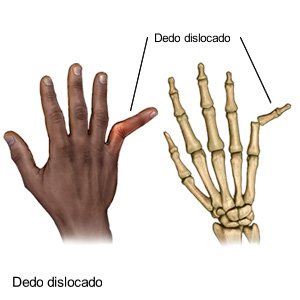 Dedo dislocado