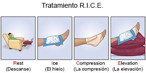 Tratamiento R.I.C.E.