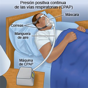 Apnea del sueño: cómo la máquina CPAP puede ayudar, Diario