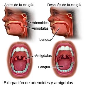 Extirpación de adenoides y amígdalas