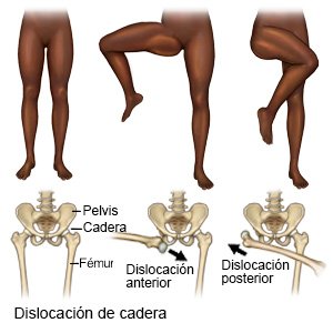 Dislocación de cadera