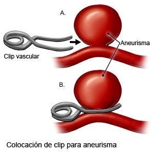 Colocación de clip para aneurisma