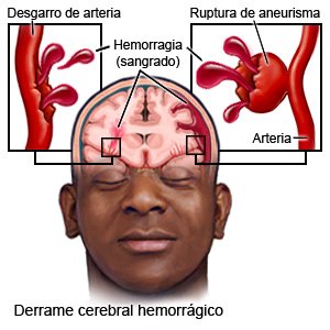 Derrame cerebral hemorrágico