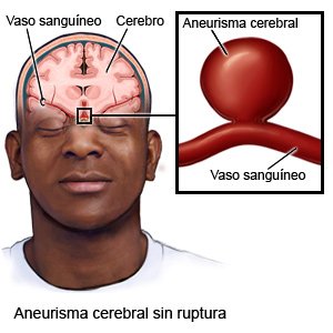Aneurisma cerebral sin ruptura