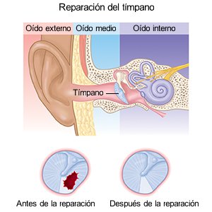 Reparación del tímpano