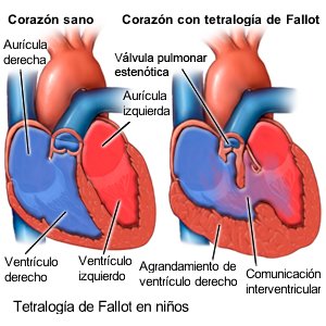 Tetralogía de Fallot en niños