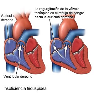 Insuficiencia tricuspídea