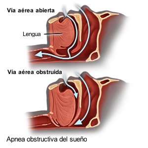 Apnea obstructiva del sueño