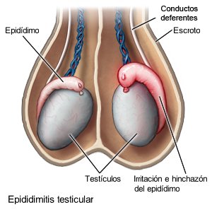 Epididimitis testicular