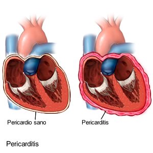 Pericarditis