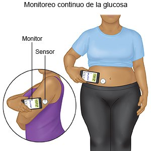 Monitoreo continuo de la glucosa