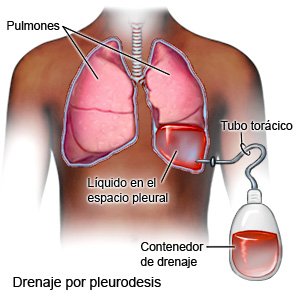 Drenaje por pleurodesis