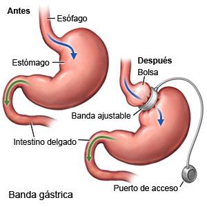 Banda gástrica