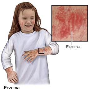 Eczema