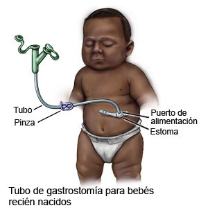Tubo de gastrostomía para bebés recién nacidos
