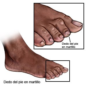 Dedo del pie en martillo