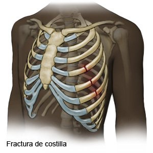 Fractura de costilla