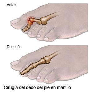 Cirugía del dedo del pie en martillo