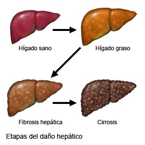 Etapas del daño hepático