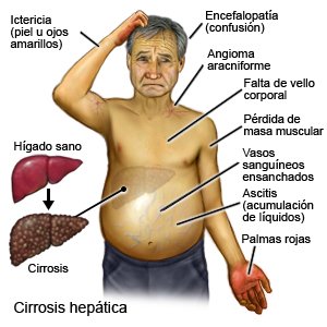 Cirrosis hepática