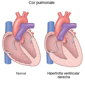 Cor pulmonale