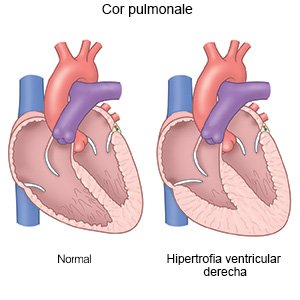 Cor pulmonale