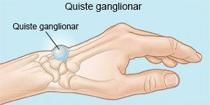 Quiste ganglionar