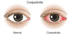 Conjuntivitis