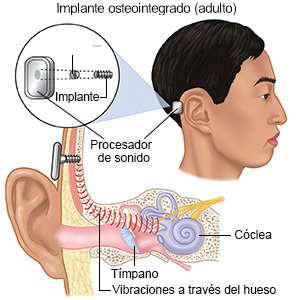 Implante osteointegrado (adulto)