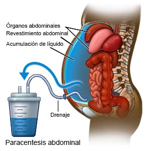 Paracentesis abdominal