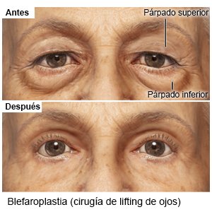 Blefaroplastia