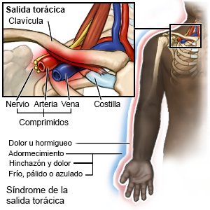 Síndrome de la salida torácica