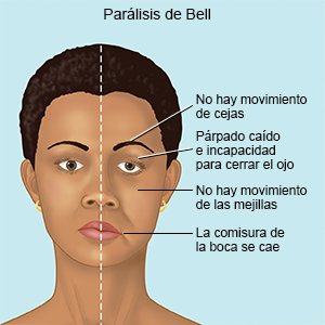 Parálisis de Bell