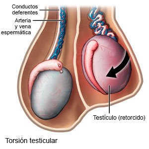 Torsión testicular