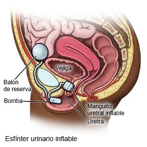 Esfínter urinario inflable para mujeres
