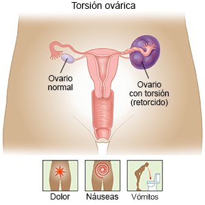 Torsión ovárica