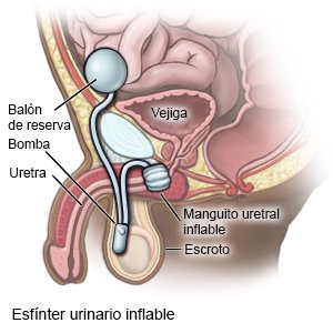 Esfínter urinario inflable para hombres