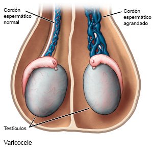 Varicocele