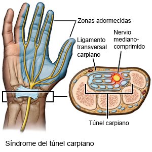 Cuáles son síntomas y tratamiento del síndrome del túnel carpiano?