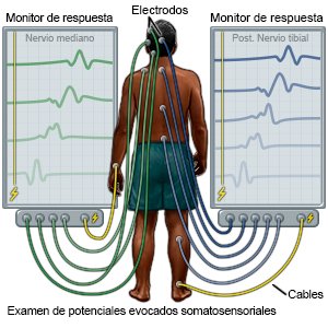 Examen de potenciales evocados somatosensoriales