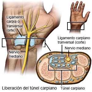 Liberación del túnel carpiano