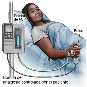 Bomba de analgesia controlada por el paciente
