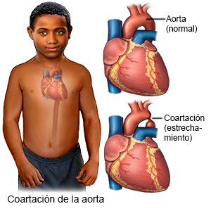 Coartación de la aorta