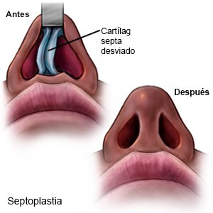 Septoplastia